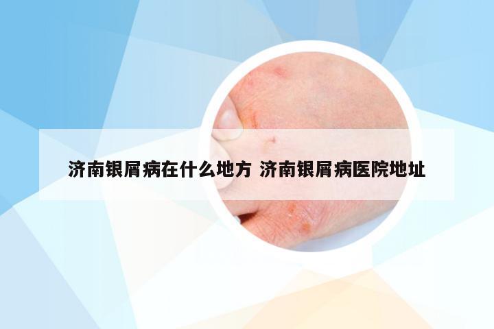 济南银屑病在什么地方 济南银屑病医院地址