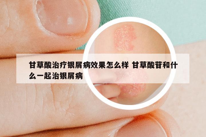 甘草酸治疗银屑病效果怎么样 甘草酸苷和什么一起治银屑病