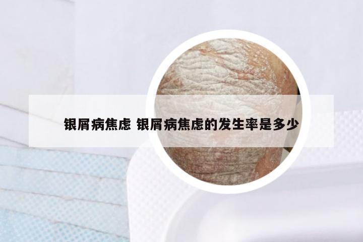 银屑病焦虑 银屑病焦虑的发生率是多少