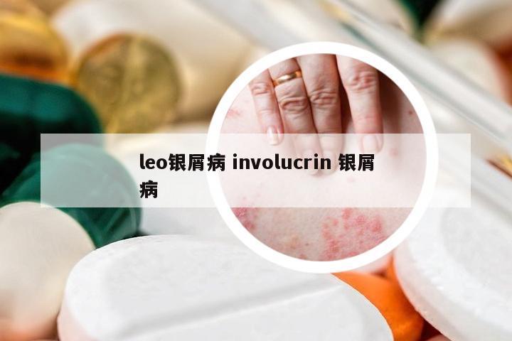 leo银屑病 involucrin 银屑病