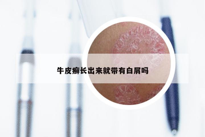 牛皮癣长出来就带有白屑吗