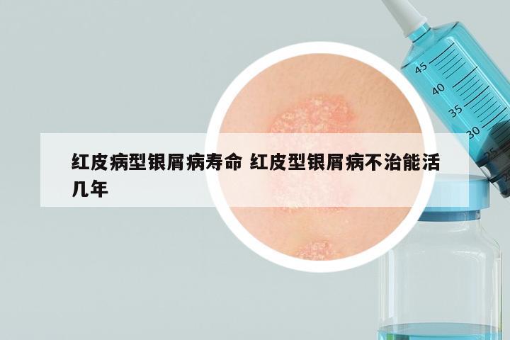 红皮病型银屑病寿命 红皮型银屑病不治能活几年