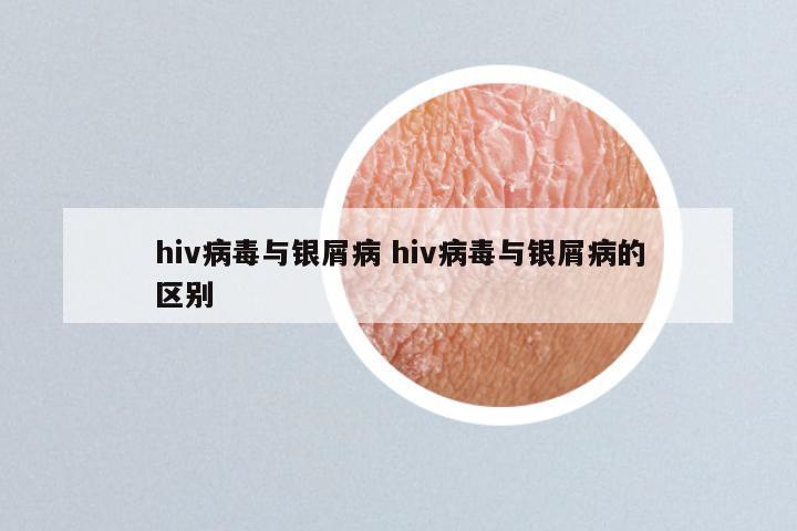 hiv病毒与银屑病 hiv病毒与银屑病的区别