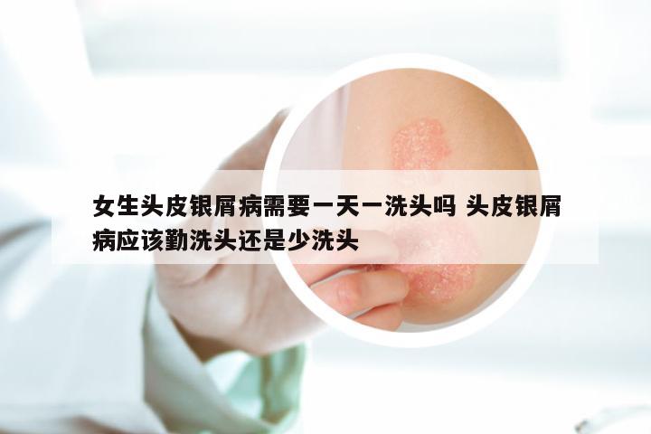 女生头皮银屑病需要一天一洗头吗 头皮银屑病应该勤洗头还是少洗头