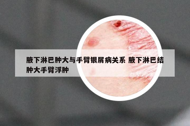 腋下淋巴肿大与手臂银屑病关系 腋下淋巴结肿大手臂浮肿