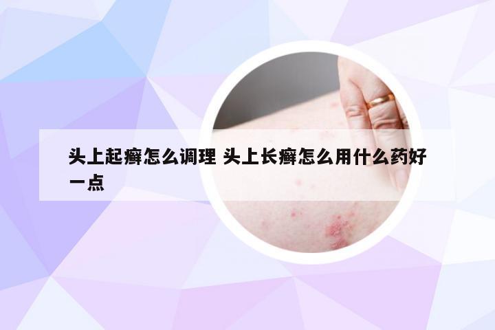 头上起癣怎么调理 头上长癣怎么用什么药好一点