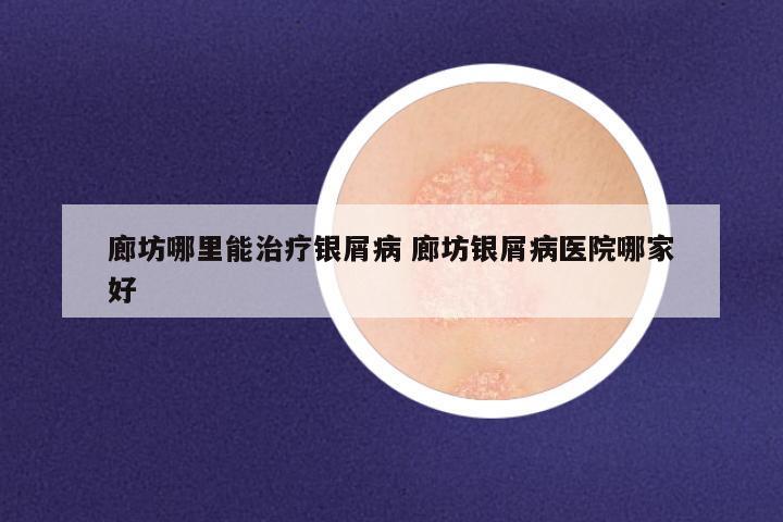 廊坊哪里能治疗银屑病 廊坊银屑病医院哪家好