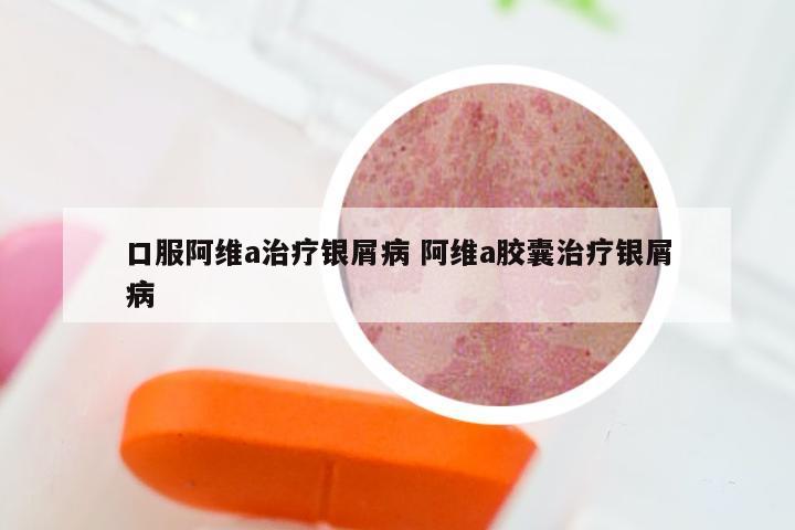 口服阿维a治疗银屑病 阿维a胶囊治疗银屑病