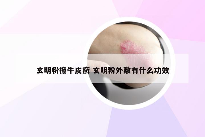 玄明粉擦牛皮癣 玄明粉外敷有什么功效