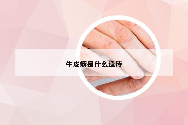 牛皮癣是什么遗传