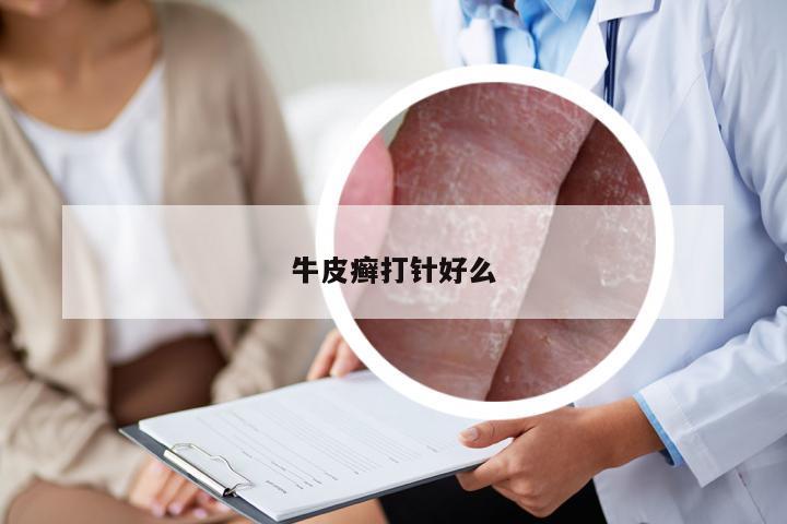 牛皮癣打针好么