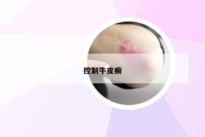 控制牛皮癣