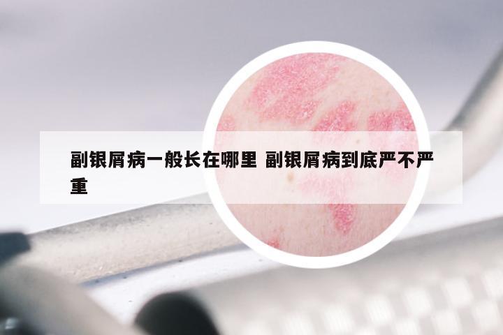 副银屑病一般长在哪里 副银屑病到底严不严重
