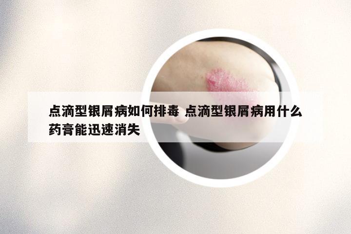 点滴型银屑病如何排毒 点滴型银屑病用什么药膏能迅速消失