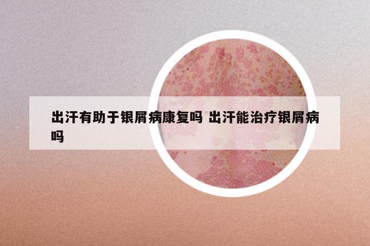 出汗有助于银屑病康复吗 出汗能治疗银屑病吗