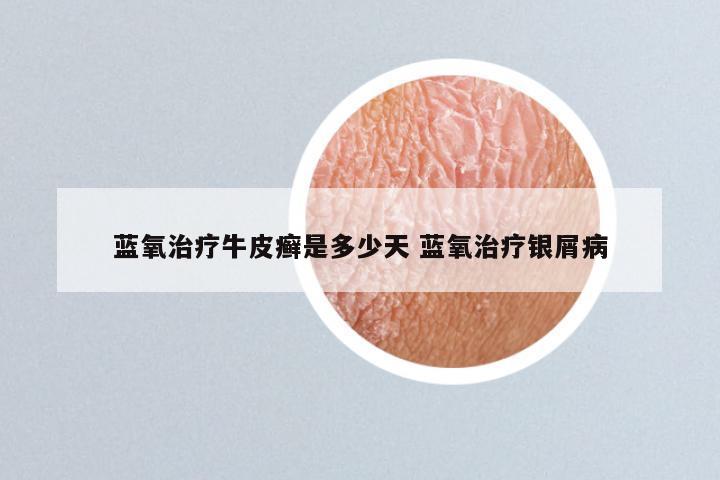 蓝氧治疗牛皮癣是多少天 蓝氧治疗银屑病