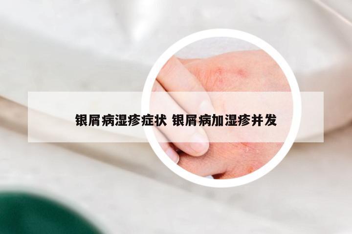 银屑病湿疹症状 银屑病加湿疹并发