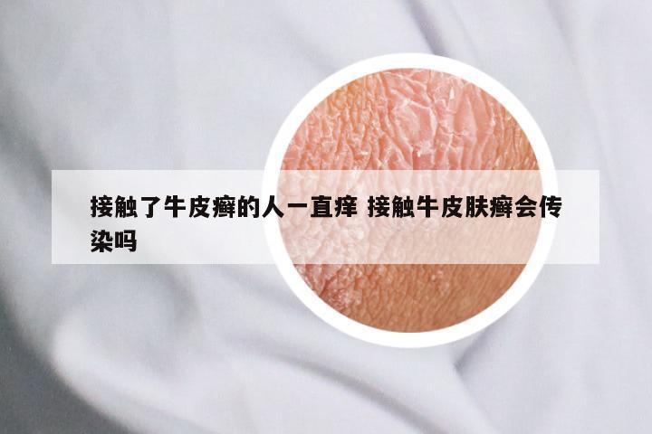接触了牛皮癣的人一直痒 接触牛皮肤癣会传染吗