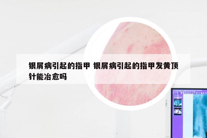 银屑病引起的指甲 银屑病引起的指甲发黄顶针能冶愈吗