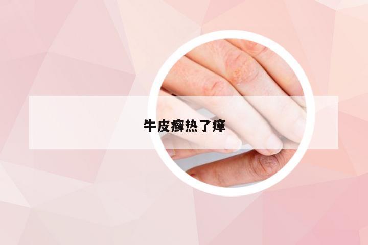 牛皮癣热了痒
