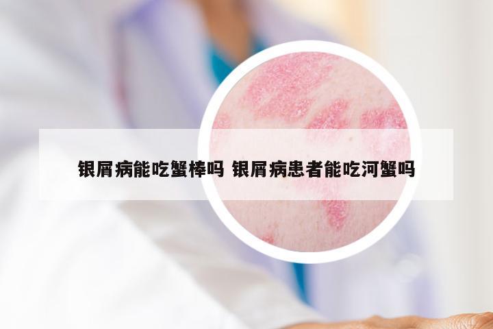 银屑病能吃蟹棒吗 银屑病患者能吃河蟹吗