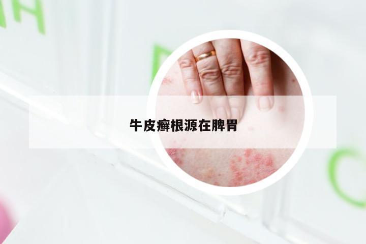 牛皮癣根源在脾胃