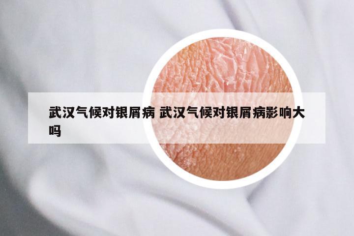 武汉气候对银屑病 武汉气候对银屑病影响大吗
