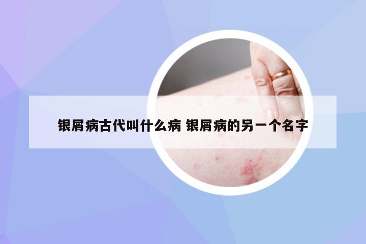 银屑病古代叫什么病 银屑病的另一个名字