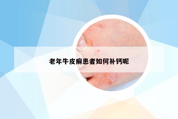 老年牛皮癣患者如何补钙呢