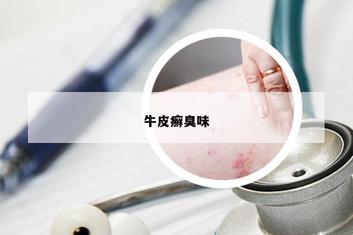 牛皮癣臭味