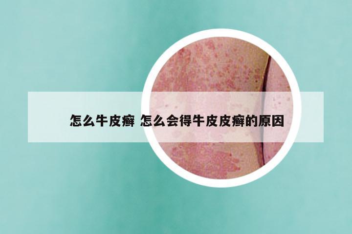 怎么牛皮癣 怎么会得牛皮皮癣的原因