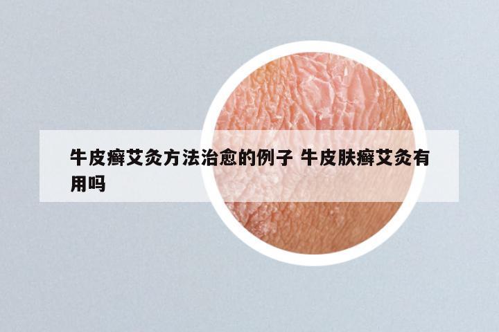 牛皮癣艾灸方法治愈的例子 牛皮肤癣艾灸有用吗