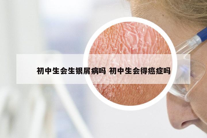 初中生会生银屑病吗 初中生会得癌症吗
