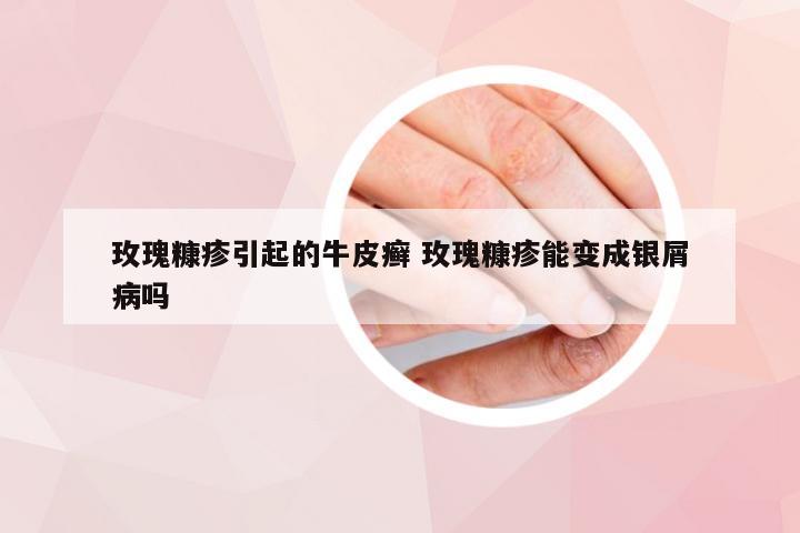 玫瑰糠疹引起的牛皮癣 玫瑰糠疹能变成银屑病吗