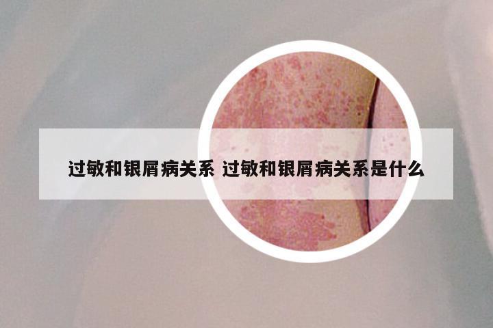 过敏和银屑病关系 过敏和银屑病关系是什么