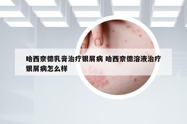 哈西奈德乳膏治疗银屑病 哈西奈德溶液治疗银屑病怎么样