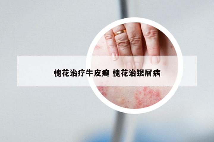 槐花治疗牛皮癣 槐花治银屑病