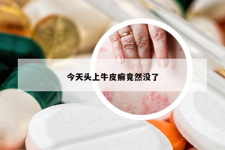 今天头上牛皮癣竟然没了