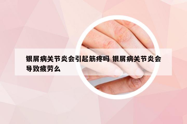 银屑病关节炎会引起筋疼吗 银屑病关节炎会导致疲劳么