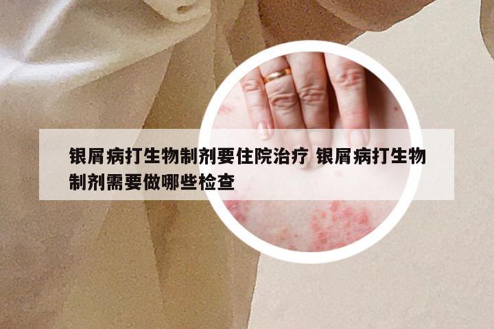 银屑病打生物制剂要住院治疗 银屑病打生物制剂需要做哪些检查