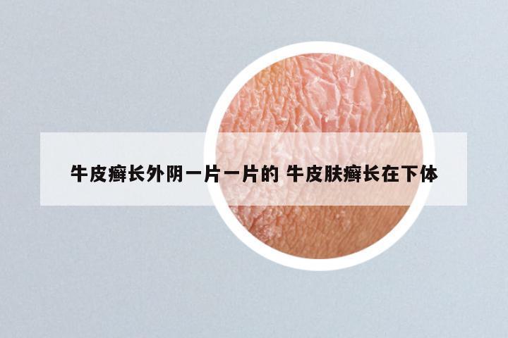 牛皮癣长外阴一片一片的 牛皮肤癣长在下体