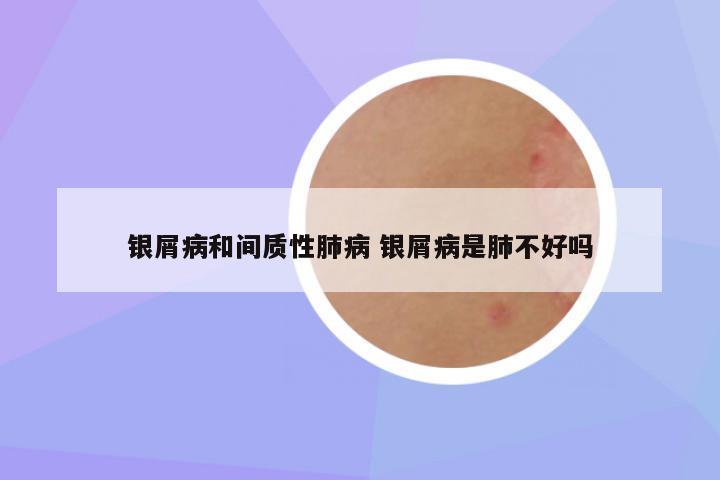 银屑病和间质性肺病 银屑病是肺不好吗