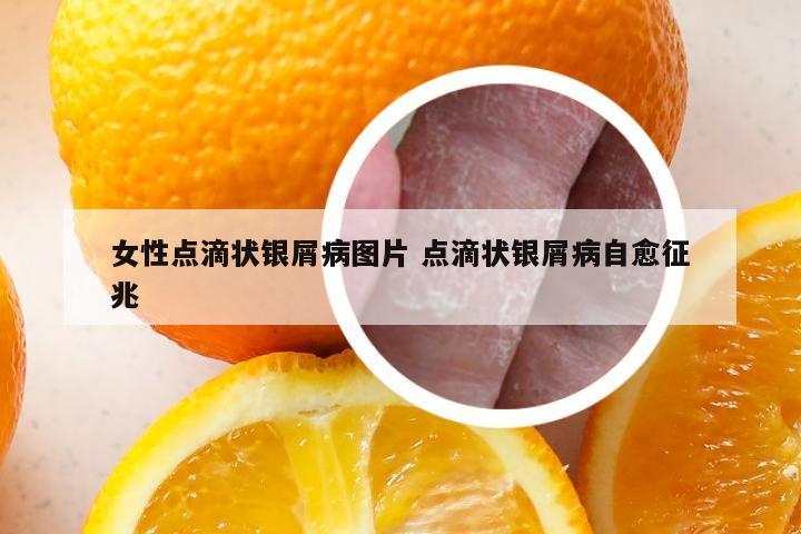 女性点滴状银屑病图片 点滴状银屑病自愈征兆