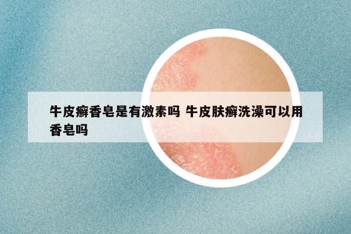 牛皮癣香皂是有激素吗 牛皮肤癣洗澡可以用香皂吗