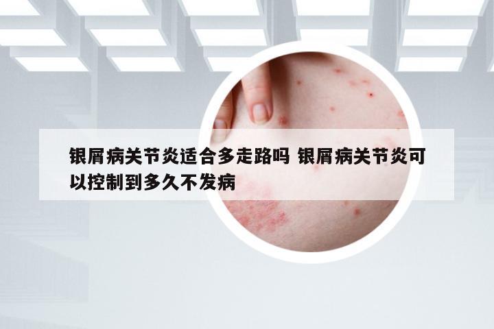 银屑病关节炎适合多走路吗 银屑病关节炎可以控制到多久不发病