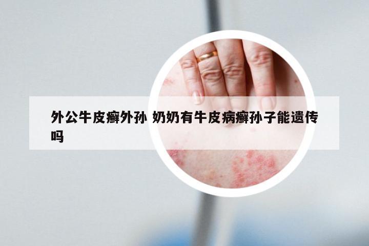 外公牛皮癣外孙 奶奶有牛皮病癣孙子能遗传吗