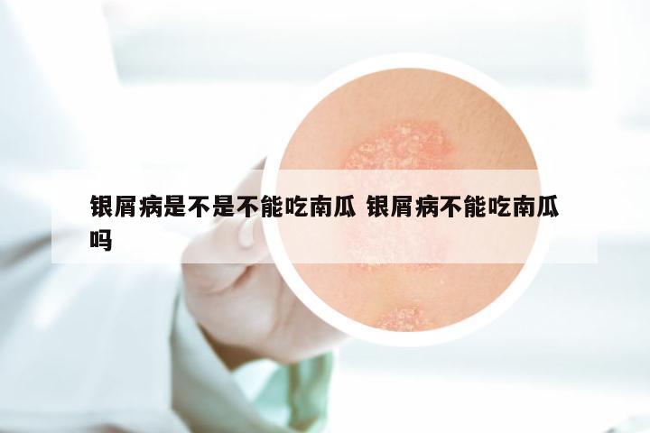 银屑病是不是不能吃南瓜 银屑病不能吃南瓜吗