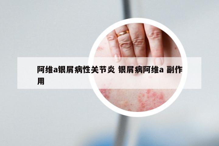 阿维a银屑病性关节炎 银屑病阿维a 副作用