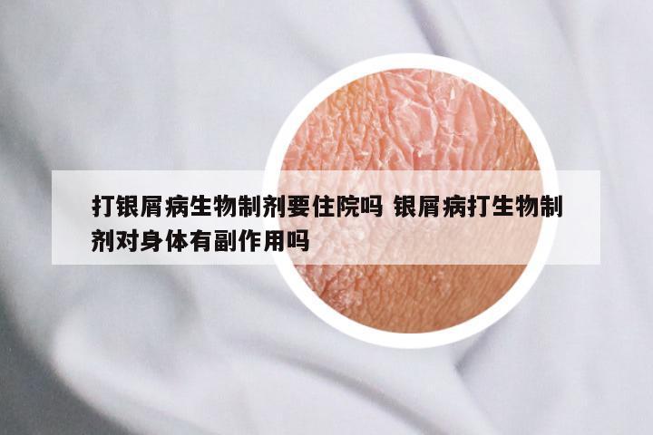 打银屑病生物制剂要住院吗 银屑病打生物制剂对身体有副作用吗