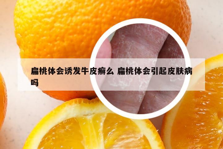 扁桃体会诱发牛皮癣么 扁桃体会引起皮肤病吗